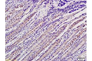 Formalin-fixed and paraffin embedded human gastric cancer labeled with Anti-ADM2 Polyclonal Antibody, Unconjugated (ABIN682483) followed by conjugation to the secondary antibody and DAB staining (Adrenomedullin 2 antibody  (AA 75-148))