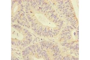 Immunohistochemistry of paraffin-embedded human colon cancer using ABIN7145574 at dilution of 1:100 (MTHFD2 antibody  (AA 40-250))