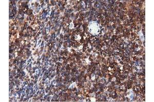 Immunohistochemical staining of paraffin-embedded Human lymphoma tissue using anti-ARHGAP25 mouse monoclonal antibody. (ARHGAP25 antibody)