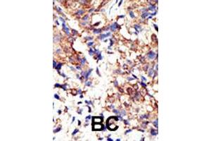 Formalin-fixed and paraffin-embedded human cancer tissue reacted with UBQLN2 polyclonal antibody  , which was peroxidase-conjugated to the secondary antibody, followed by DAB staining. (Ubiquilin 2 antibody  (N-Term))
