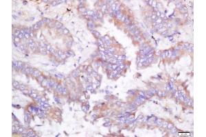 Formalin-fixed and paraffin embedded human lung carcinoma labeled with Rabbit Anti-ODC Polyclonal Antibody, Unconjugated (ABIN674559) at 1:200 followed by conjugation to the secondary antibody and DAB staining (ODC1 antibody  (AA 321-461))
