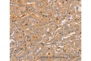 Immunohistochemistry of Human liver cancer using CCL16  Polyclonal Antibody at dilution of 1:60 (CCL16 antibody)