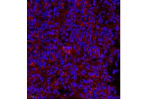 Immunofluorescence of paraffin embedded human bladder cancer using MYL6 (ABIN7074734) at dilution of 1:650 (400x lens) (MYL6 antibody)