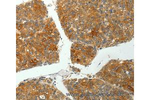 Immunohistochemistry of Human liver cancer using PTPN6 Polyclonal Antibody at dilution of 1:35