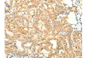 The image on the left is immunohistochemistry of paraffin-embedded Human thyroid cancer tissue using ABIN7131115(SNAP25 Antibody) at dilution 1/25, on the right is treated with fusion protein. (SNAP25 antibody)