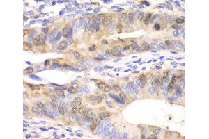 Immunohistochemistry of paraffin-embedded Human colon carcinoma using UBE2C Polyclonal Antibody at dilution of 1:100 (40x lens). (UBE2C antibody)