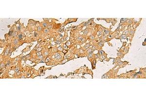 Immunohistochemistry of paraffin-embedded Human breast cancer tissue using CXCL1 Polyclonal Antibody at dilution of 1:35(x200) (CXCL1 antibody)