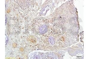 Formalin-fixed and paraffin-embedded human oral squamous cell carcinoma labeled with Rabbit Anti-Ki-67 Polyclonal Antibody, Unconjugated (ABIN677858) at 1:200 followed by conjugation to the secondary antibody and DAPI staining