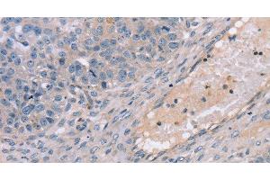 Immunohistochemistry of paraffin-embedded Human breast cancer using TERT Polyclonal Antibody at dilution of 1:35 (TERT antibody)
