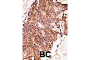 Formalin-fixed and paraffin-embedded human cancer tissue reacted with BMP1 polyclonal antibody  , which was peroxidase-conjugated to the secondary antibody, followed by AEC staining. (BMP1 antibody  (C-Term))