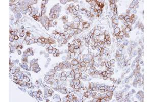 IHC-P Image Immunohistochemical analysis of paraffin-embedded OVCAR3 xenograft , using SNTB2, antibody at 1:500 dilution.