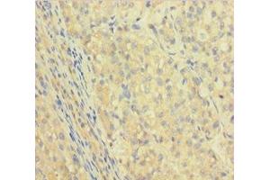 Immunohistochemistry of paraffin-embedded human liver cancer using ABIN7156085 at dilution of 1:100 (IGHG1 antibody  (AA 1-330))