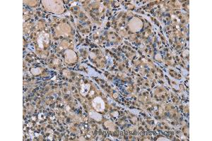 Immunohistochemistry of Human esophagus cancer using DYNLL1 Polyclonal Antibody at dilution of 1:30