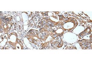Immunohistochemistry of paraffin-embedded Human colorectal cancer tissue using APOD Polyclonal Antibody at dilution of 1:55(x200) (Apolipoprotein D antibody)