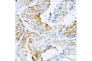 Immunohistochemistry of paraffin-embedded human colon carcinoma using APOC1 antibody at dilution of 1:100 (40x lens).