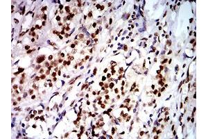 Immunohistochemical analysis of paraffin-embedded bladder cancer tissues using DDX1 mouse mAb with DAB staining. (DDX1 antibody  (AA 642-740))
