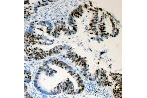 Immunohistochemical analysis of Lamin A/C (pS392) staining in human colon cancer formalin fixed paraffin embedded tissue section.