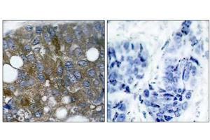Immunohistochemical analysis of paraffin- embedded human breast carcinoma tissue using HSP27 (phospho-Ser15) antibody (E011164). (HSP27 antibody  (pSer15))