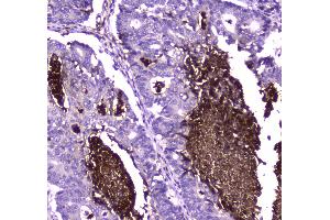 IHC analysis of Lactoferrin using anti-Lactoferrin antibody . (Lactoferrin antibody  (AA 529-710))