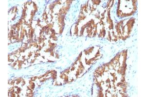 Formalin-fixed, paraffin-embedded human Prostate Carcinoma stained with IDH1 Mouse Monoclonal Antibody (IDH1/1152). (IDH1 antibody  (AA 281-414))