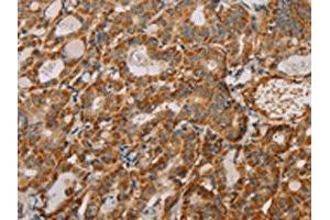 The image on the left is immunohistochemistry of paraffin-embedded Human thyroid cancer tissue using ABIN7130292(MTFR1 Antibody) at dilution 1/40, on the right is treated with fusion protein.