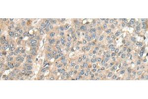Immunohistochemistry of paraffin-embedded Human liver cancer tissue using CASQ1 Polyclonal Antibody at dilution of 1:100(x200) (Calsequestrin antibody)