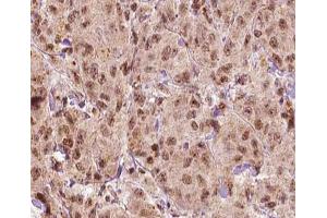 ABIN6266879 at 1/100 staining human Breast carcinoma tissue sections by IHC-P. (MAGEA1 antibody  (C-Term))