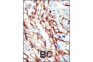 Formalin-fixed and paraffin-embedded human cancer tissue reacted with the primary antibody, which was peroxidase-conjugated to the secondary antibody, followed by AEC staining. (EPH Receptor A7 antibody  (C-Term))