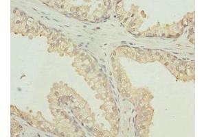 Immunohistochemistry of paraffin-embedded human prostate cancer using ABIN7167501 at dilution of 1:100 (PTPRB antibody  (AA 1758-1997))