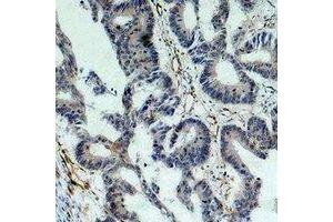 Immunohistochemical analysis of Survivin staining in human colon cancer formalin fixed paraffin embedded tissue section. (Survivin antibody)
