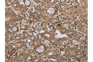 The image on the left is immunohistochemistry of paraffin-embedded Human thyroid cancer tissue using ABIN7192692(STMN2/STMN3/STMN4 Antibody) at dilution 1/45, on the right is treated with synthetic peptide. (STMN2/STMN3/STMN4 antibody)