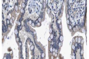 ABIN6266560 at 1/100 staining human colon carcinoma tissue sections by IHC-P.