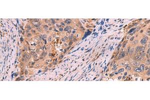 Immunohistochemistry of paraffin-embedded Human cervical cancer tissue using SHC4 Polyclonal Antibody at dilution of 1:85(x200) (SHC4 antibody)