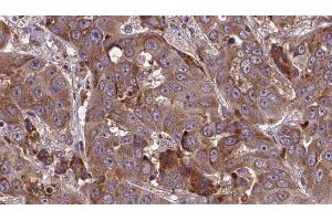 ABIN6277708 at 1/100 staining Human liver cancer tissue by IHC-P. (SLC3A2 antibody  (Internal Region))