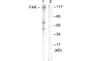 Immunohistochemistry analysis of paraffin-embedded human breast carcinoma tissue using FAK (Ab-397) antibody.