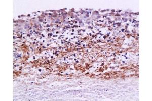 Formalin-fixed and paraffin embedded rat ovary carcinoma labeled with Anti-MMP-9 Polyclonal Antibody, Unconjugated  at 1:200, followed by conjugation to the secondary antibody and DAB staining (MMP 9 antibody  (AA 611-707))