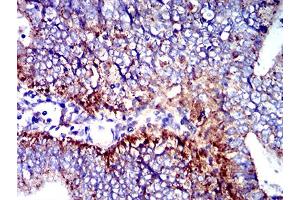Immunohistochemical analysis of paraffin-embedded endometrial cancer tissues using CD107b mouse mAb with DAB staining.