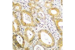 Immunohistochemical analysis of BCAR3 staining in human colon cancer formalin fixed paraffin embedded tissue section. (BCAR3 antibody  (C-Term))