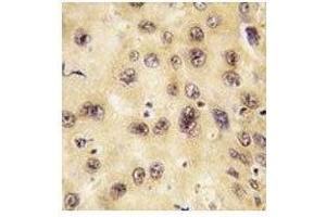 IHC analysis of FFPE human hepatocarcinoma tissue stained with PROX1 antibody (PROX1 antibody  (AA 185-214))