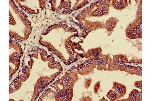 IHC image of ABIN7159999 diluted at 1:600 and staining in paraffin-embedded human prostate cancer performed on a Leica BondTM system. (ERK1 antibody  (AA 11-379))