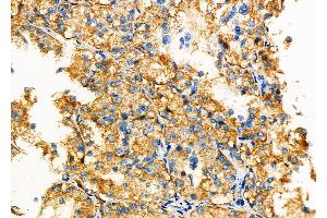 ABIN6262010 and ABIN6277327 at 1/100 staining Human kidney cancer by IHC-P. (GNAS antibody  (N-Term))