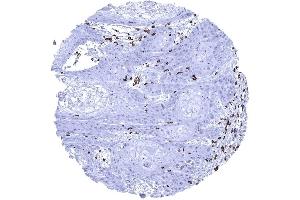 Squamous cell carcinoma containing numerous CD3 positive T lymphocytes (Recombinant CD3 antibody  (AA 20-40))