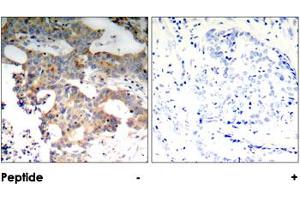 Immunohistochemical analysis of paraffin-embedded human breast carcinoma tissue using NFKBIE polyclonal antibody . (NFKBIE antibody)