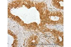 Immunohistochemistry of Human cervical cancer using TEKT1 Polyclonal Antibody at dilution of 1:30
