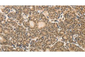 Immunohistochemistry of paraffin-embedded Human thyroid cancer tissue using MAP1A Polyclonal Antibody at dilution 1:40 (MAP1A antibody)