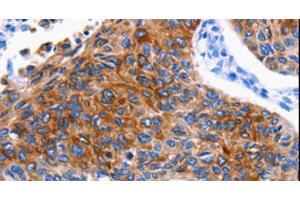 Immunohistochemistry of paraffin-embedded Human lung cancer using DRD4 Polyclonal Antibody at dilution of 1:30