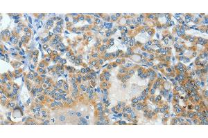 Immunohistochemistry of paraffin-embedded Human thyroid cancer using BAAT Polyclonal Antibody at dilution of 1:30 (BAAT antibody)