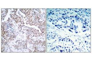 Immunohistochemical analysis of paraffin-embedded human breast carcinoma tissue using p53 (Phospho-Ser15) Antibody (left) or the same antibody preincubated with blocking peptide (right). (p53 antibody  (pSer15))