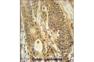AVIL Antibody (N-term) (ABIN650952 and ABIN2840008) immunohistochemistry analysis in formalin fixed and paraffin embedded human colon carcinoma followed by peroxidase conjugation of the secondary antibody and DAB staining. (Advillin antibody  (N-Term))