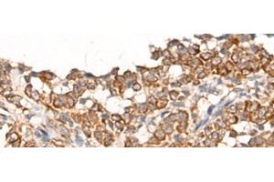 Immunohistochemistry of paraffin-embedded Human ovarian cancer tissue using CA5B Polyclonal Antibody at dilution of 1:65(x200) (CA5B antibody)